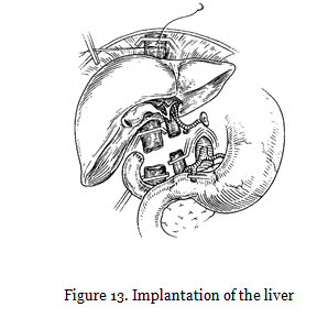 Implantation of the liver