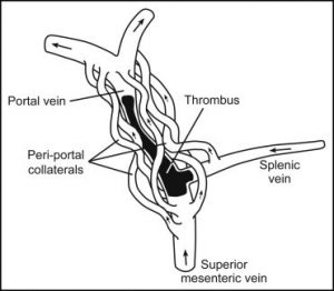 Portal vein thrombosis in children and young adults