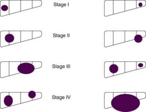 Pre-text staging system of hepatoblastoma
