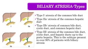 Biliary atresia types